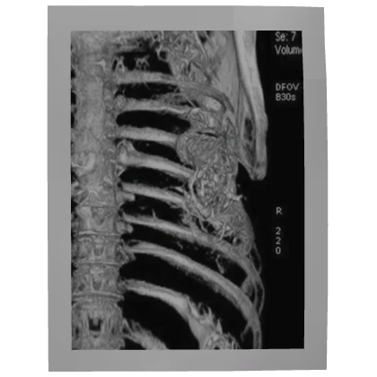 X-RAY RIBCAGE PHOTO