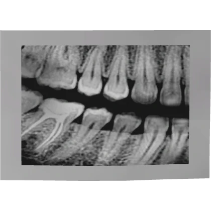 X-RAY TEETH PHOTO