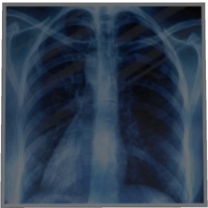 Chest XRAY Scan